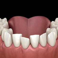 Illustration of crowded teeth