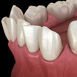 Illustration of gapped teeth