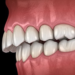 Illustration of an overbite