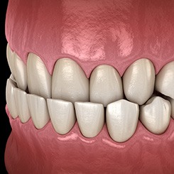 Illustration of an underbite