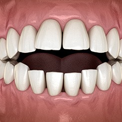 Illustration of an open bite