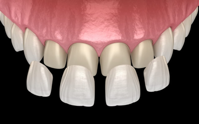 Animated smile during porcelain veneer placement