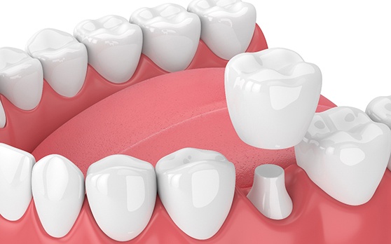 Closeup of dental crowns in Rockville on white background