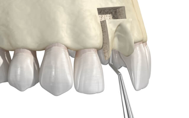 Animated smile during bone grafting treatment