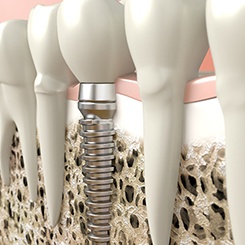 Digital illustration of dental implants