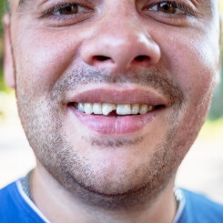 Man with chipped front tooth