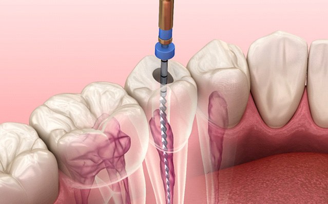Illustration of root canal therapy for lower arch