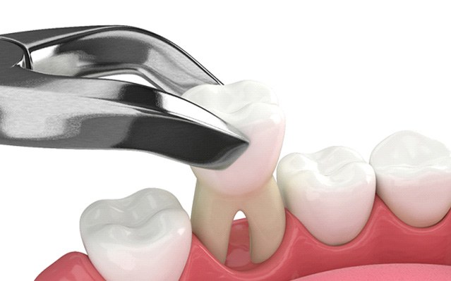 Illustration of a tooth being extracted from lower arch