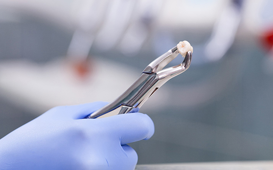 Gloved hand holding tooth in forceps after tooth extraction in Rockville, MD