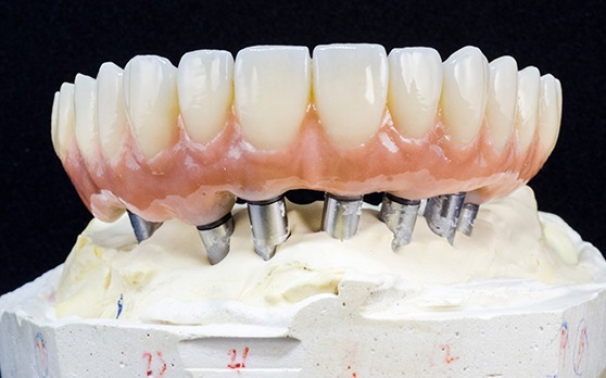 Example of Implant Dentures in Rockville