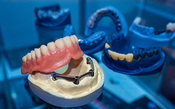Example of removable Implant Dentures in Rockville