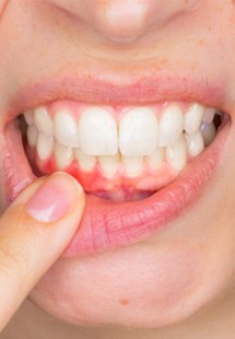Woman pointing to inflamed gums