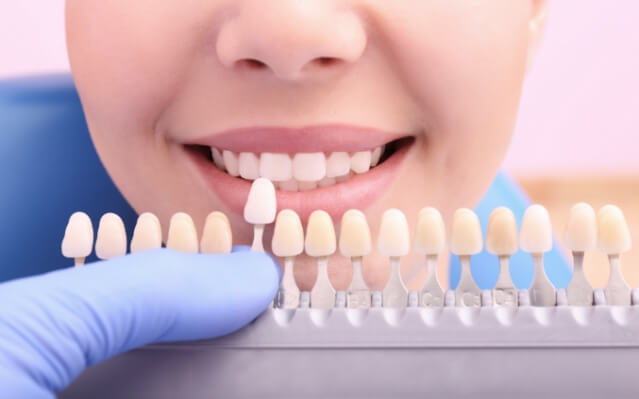 Smile compared to tooth colored filling shades during restorative dentistry visit