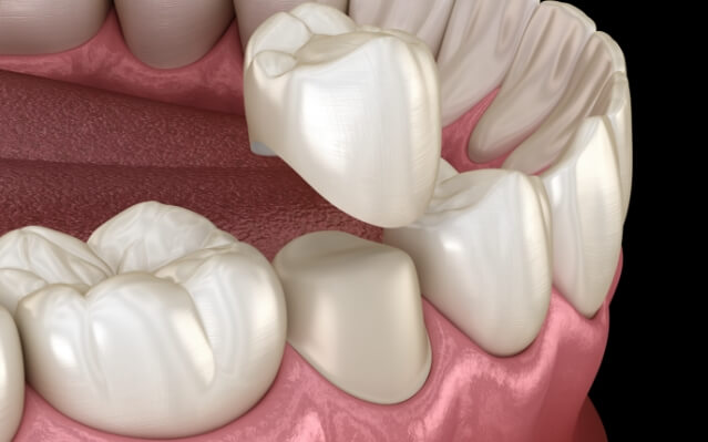 Animated smile during dental crown placement