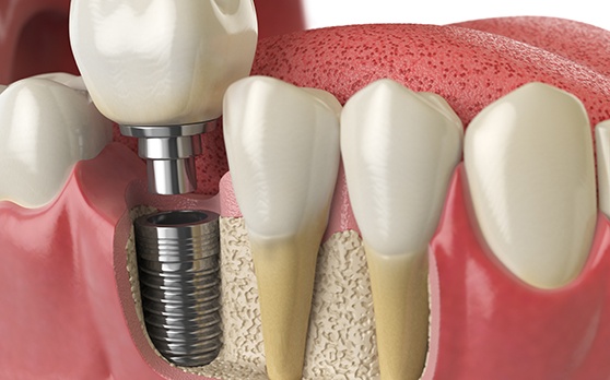 a 3D illustration of a dental implant inside a mouth