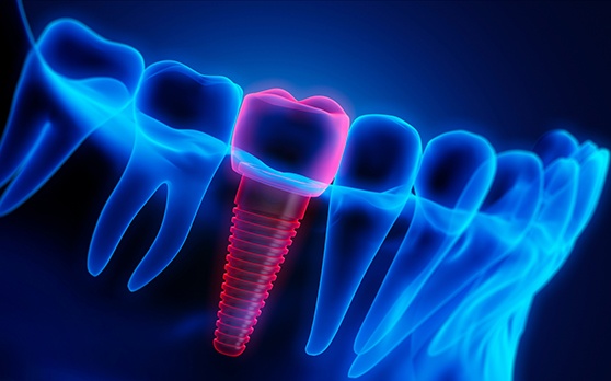 a 3D illustration representing a failed dental implant