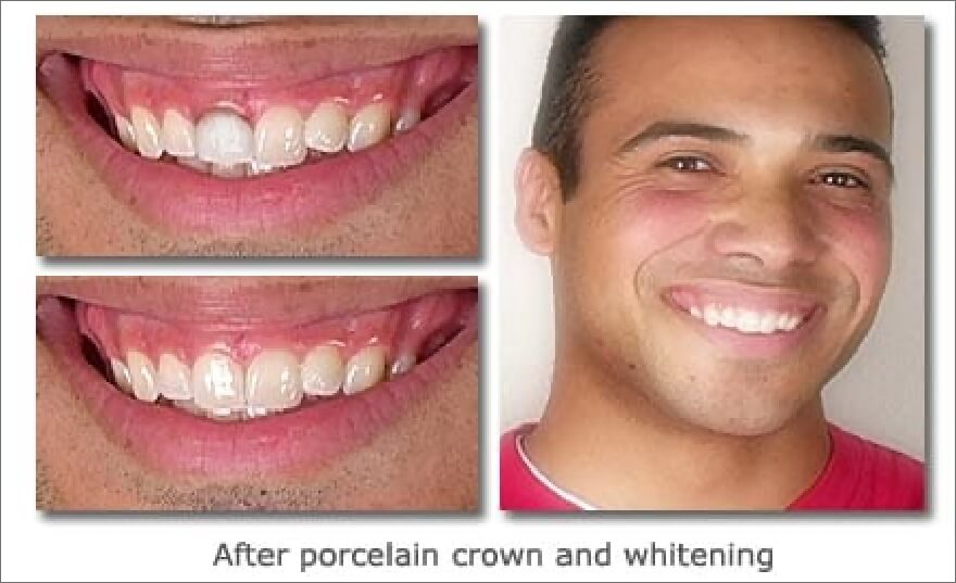 Patient's smile before and after porcelain dental crowns and teeth whitening