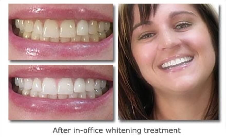 Patient's smile before and after in-office teeth whitening