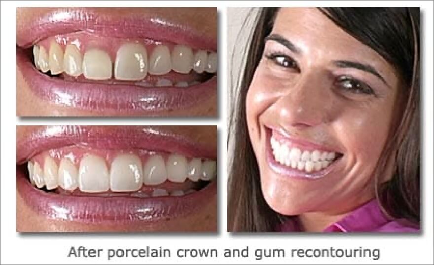 Patient's smile before and after dental crowns and gum recontouring