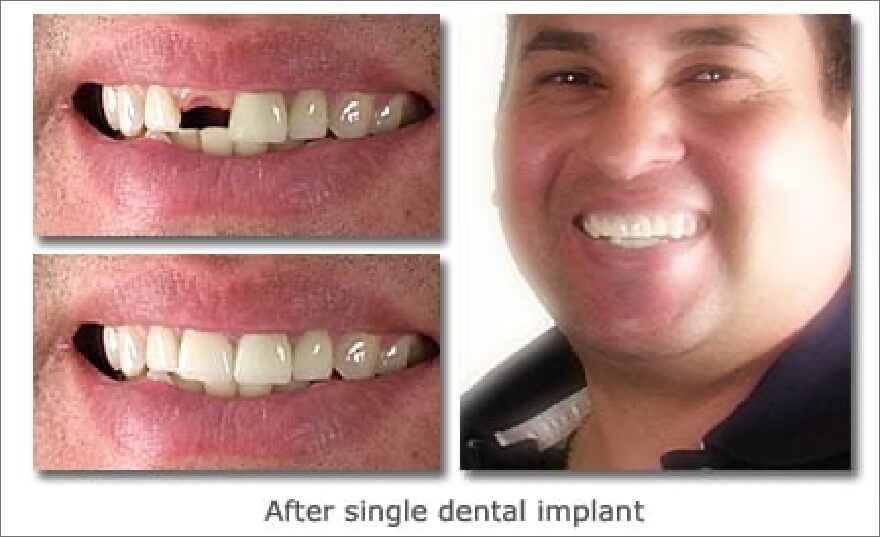 Patient's smile before and after tooth replacement with a single dental implant supported dental crown