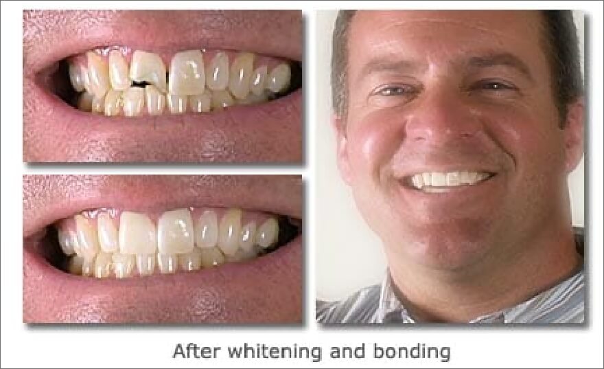 Patient's smile before and after teeth whitening and dental bonding