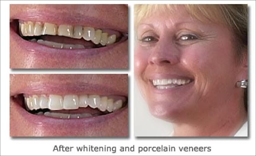 Patient's smile before and after teeth whitening and porcelain veneers