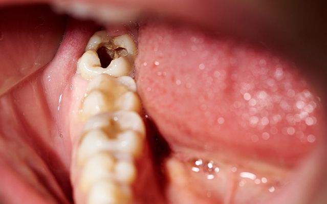 a person with a severely decayed tooth