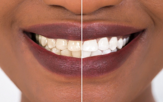 Before and after image of teeth whitening in Rockville