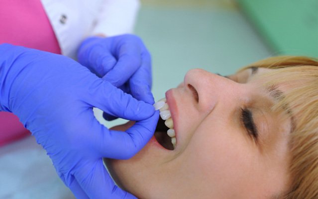 Veneers being placed on the teeth