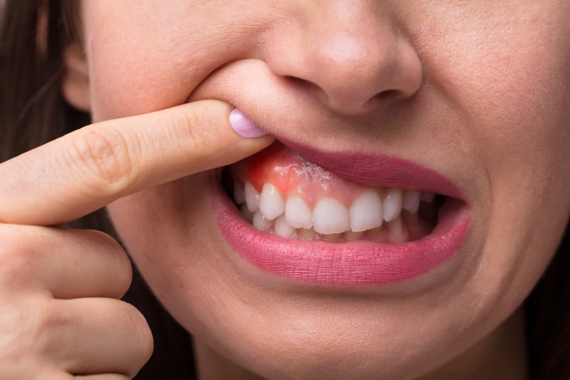 woman with sore gums