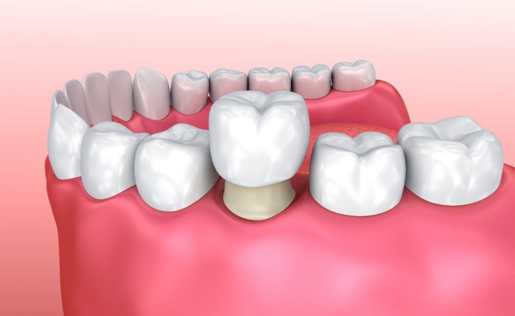 closeup illustration of dental crown