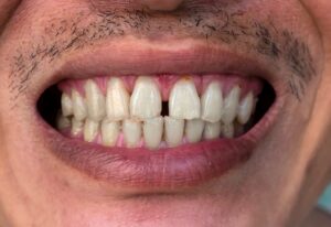 Close-up of smile showing gap between front teeth.